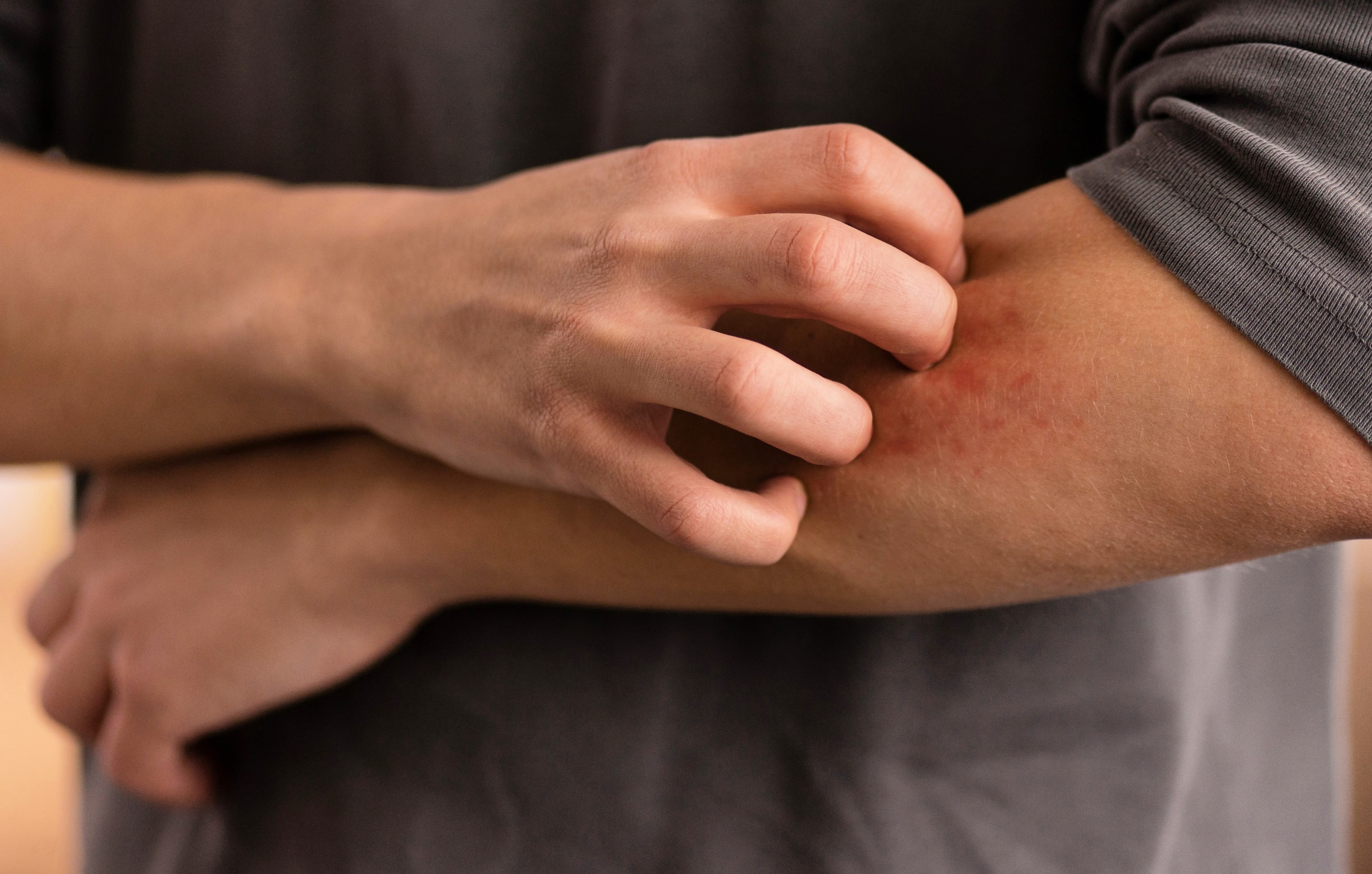 두드러기의 원인, 히스타민과 면역 반응