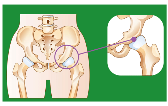 고관절 통증 증상 7가지 총정리 섬네일