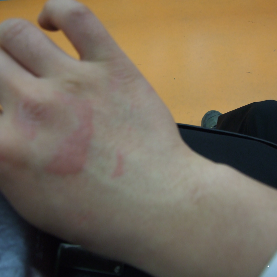 건선&amp;#44; 평생을 함께하는 만성 염증 질환