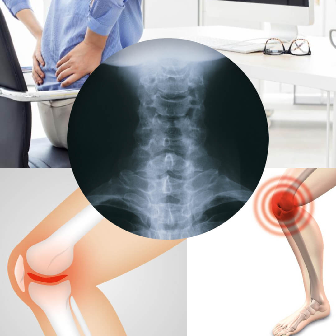 족저근막염 후유증