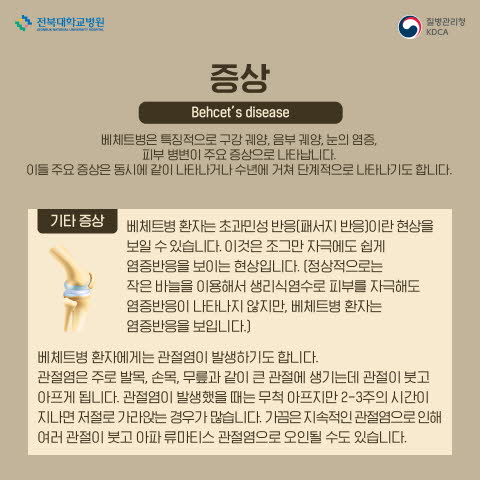 베체트병: 증상&amp;#44; 원인&amp;#44; 진단 및 치료에 대한 종합 가이드