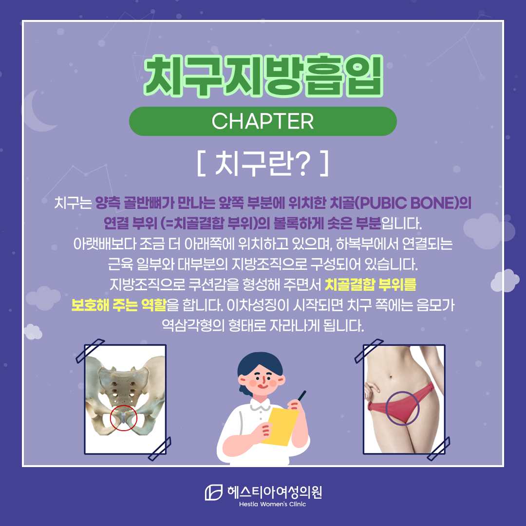 치구란?