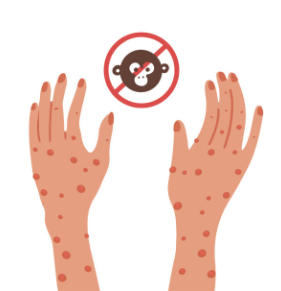 원숭이 두창 바이러스 전염 감염경로 원인 증상 예방법