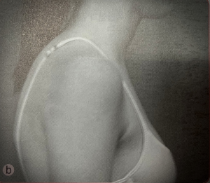 사람측면에서-어깨정렬-사진