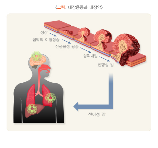 대장암 증상 총정리 : 1~3기 단계별 증상