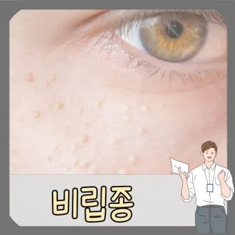 얼굴 비립종 없애는 법 자극 없이 제거하는 피부관리법_22