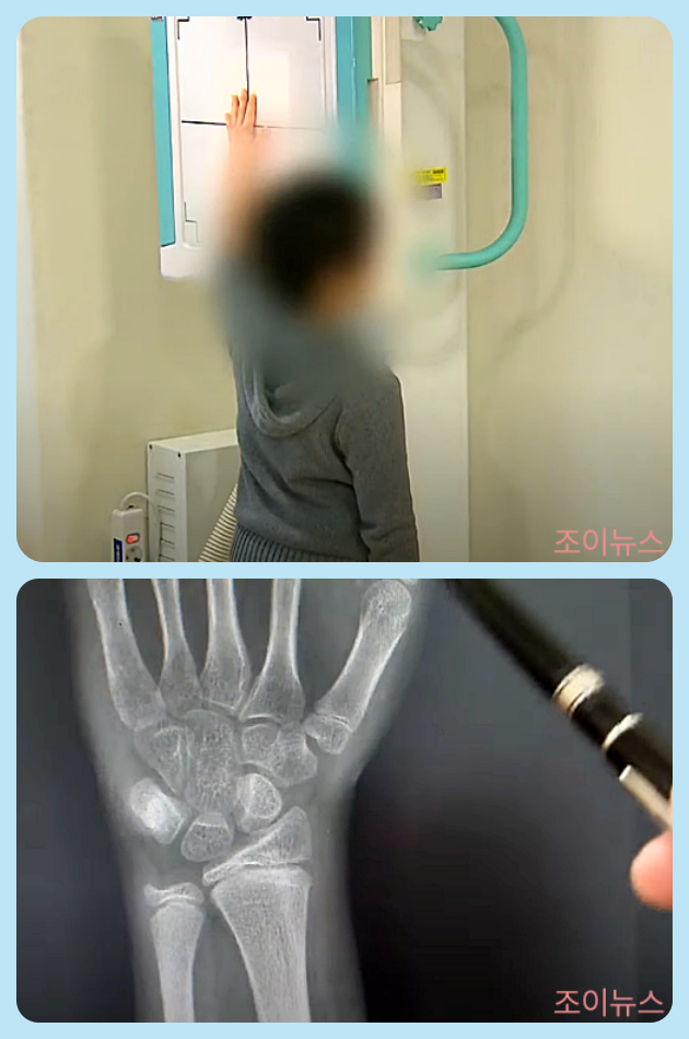 X-ray검사(손목촬영)_이미지출처: SBS뉴스