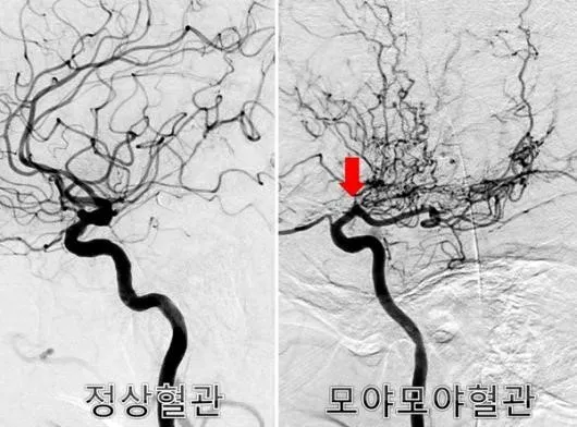 모야모야병 증상 및 원인과 장애등급 여부 알아보기