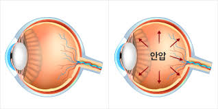 안압이 높을 때 증상