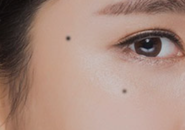 점 빼는 비용 점 빼고나서 관리법