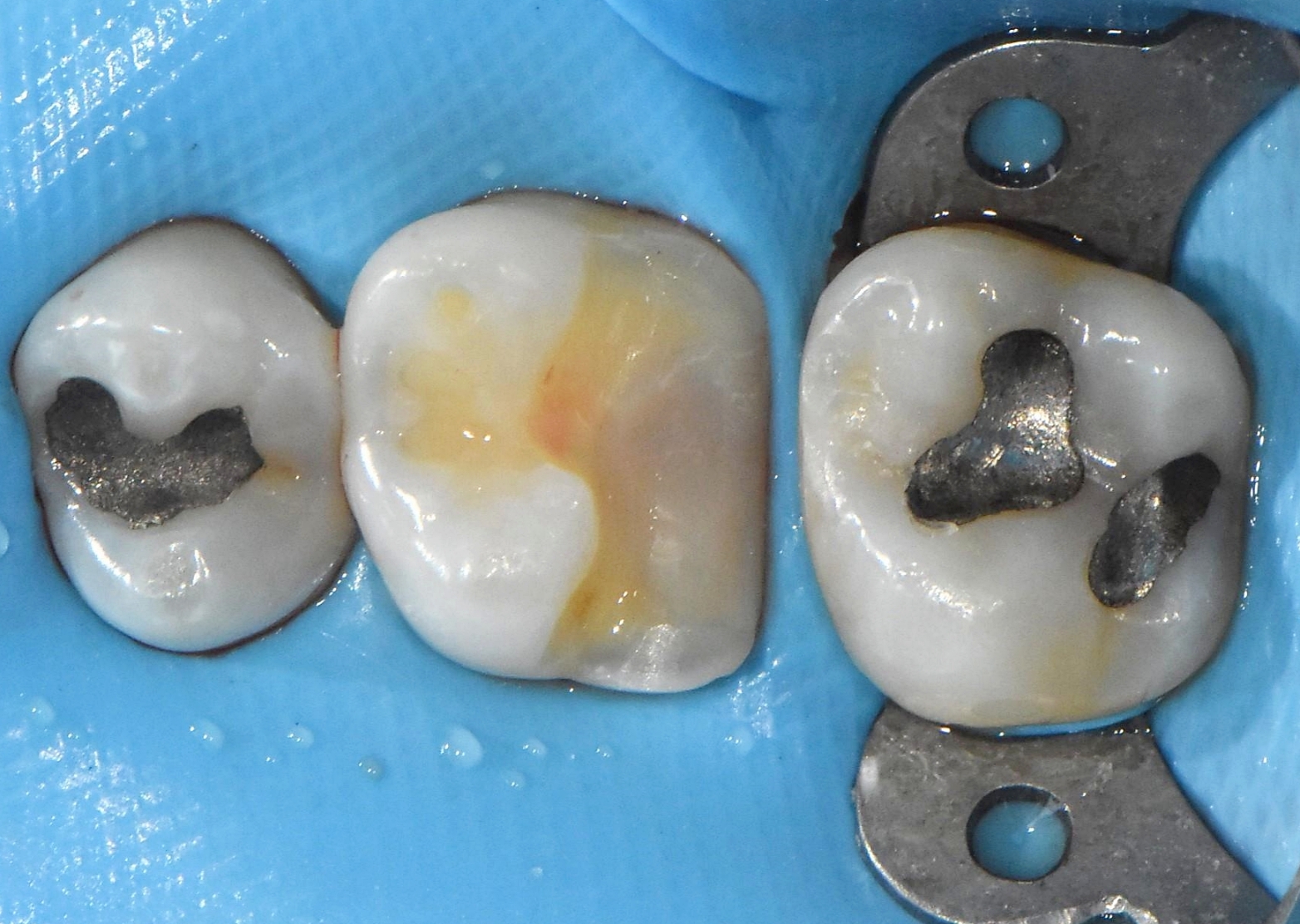어금니 충치 제거 후 레진
