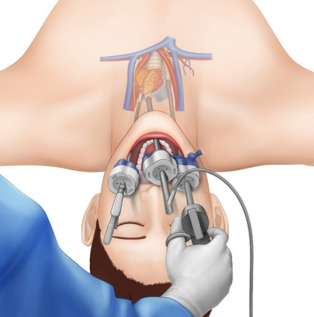 갑상선암 관련사진