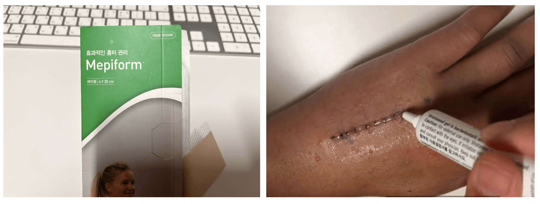 메피폼-흉터연고