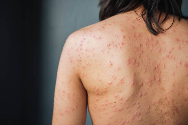 대상포진 예방접종 가격