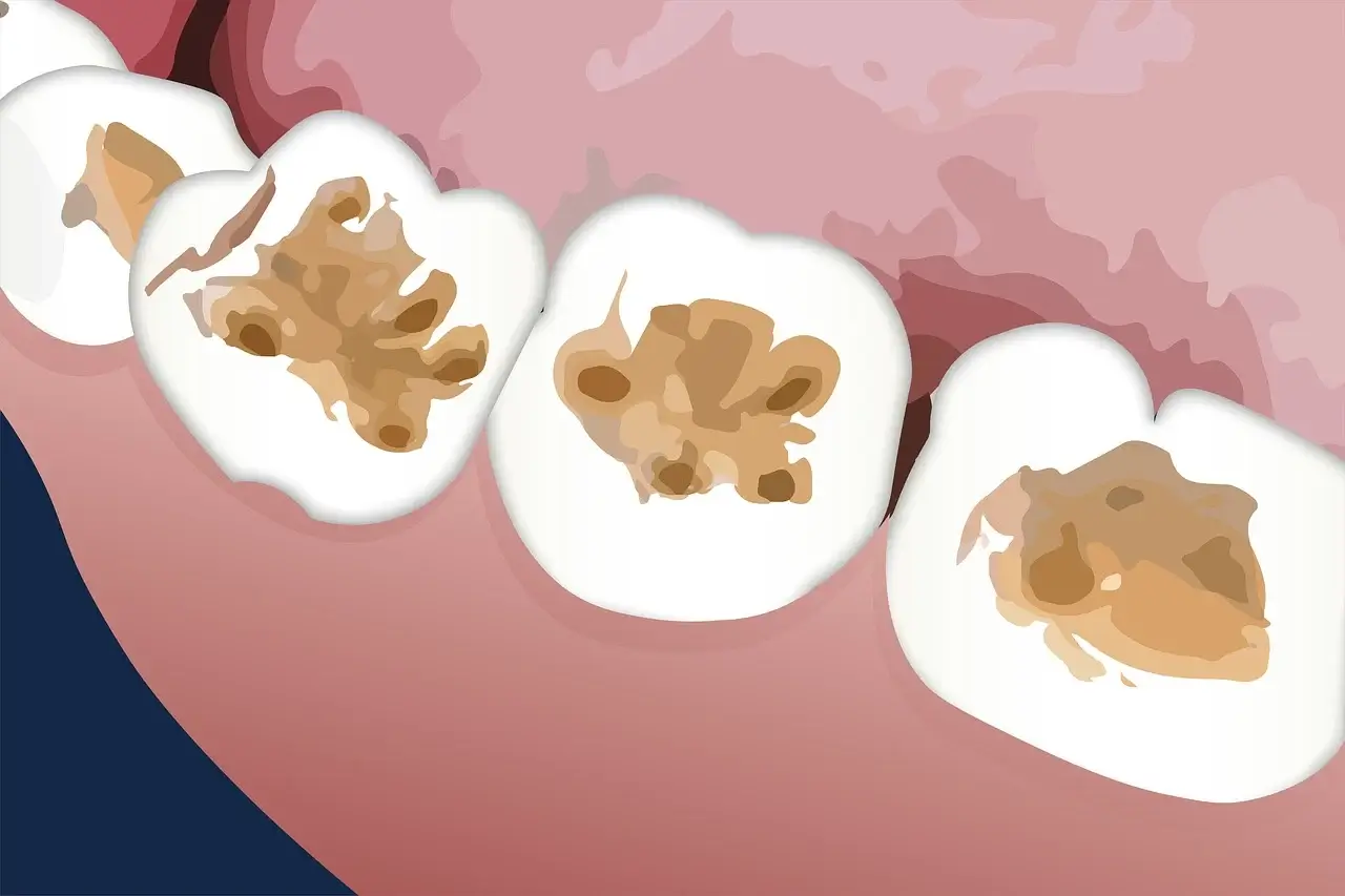 구강 건강의 기초: 충치, 잇몸병, 치주질환의 원리