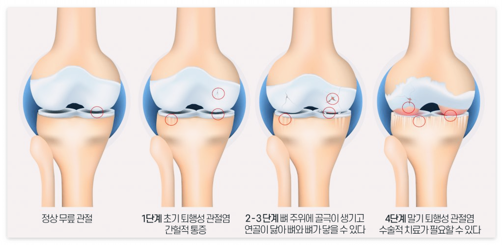 콘드로이친 효능