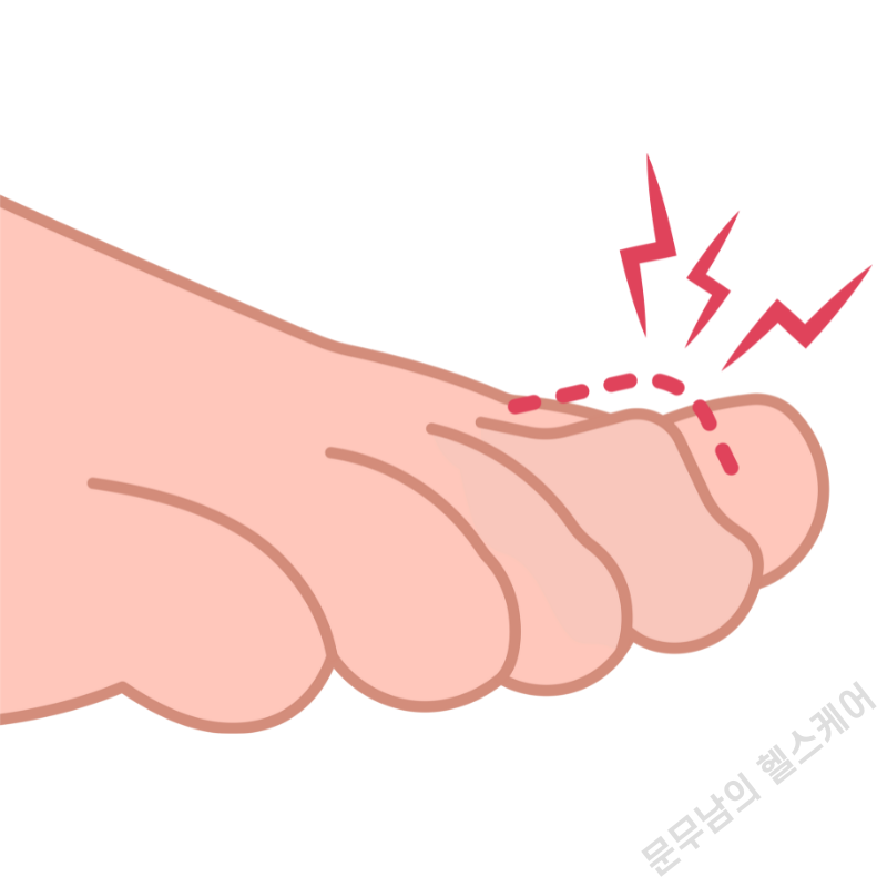 발가락 저림 증상의 원인 지간신경종