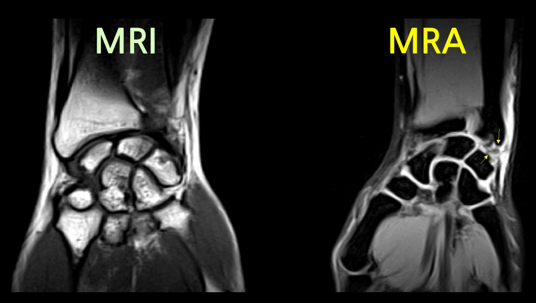 wrist-MRI-MRA
