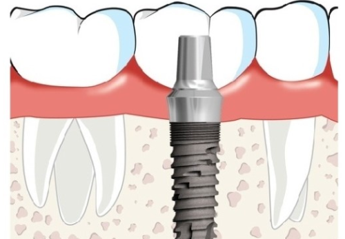 임플란트 치료기간