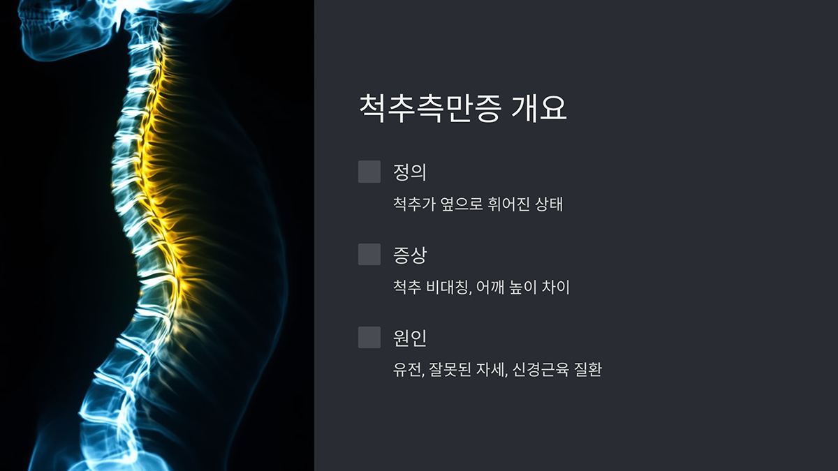 척추측만증