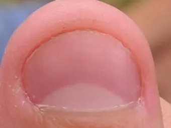 손톱이 갈라지는 이유 원인 증상 대처법_15