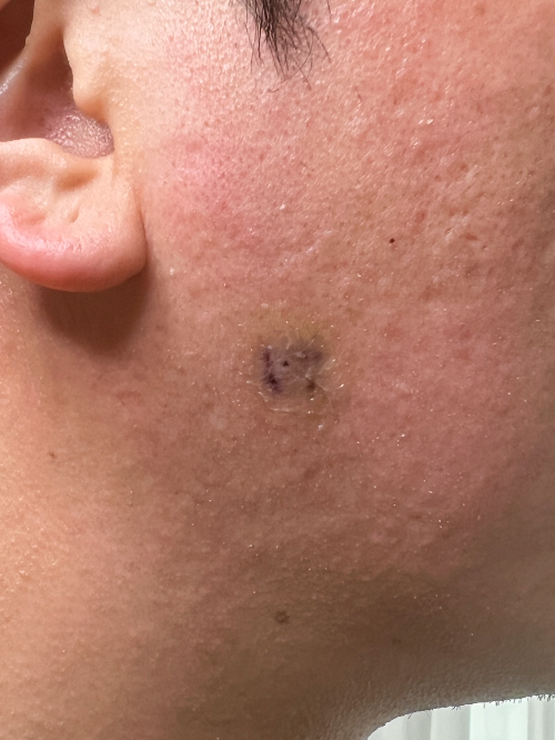 종기치료-3주차-사진