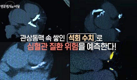 관상동맥-석회수치