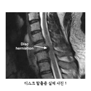 어깨통증원인