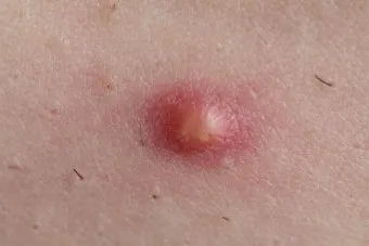 엉덩이 종기가 생기는 이유 왜 생기고 어떻게 관리할까요 완벽 가이드_5