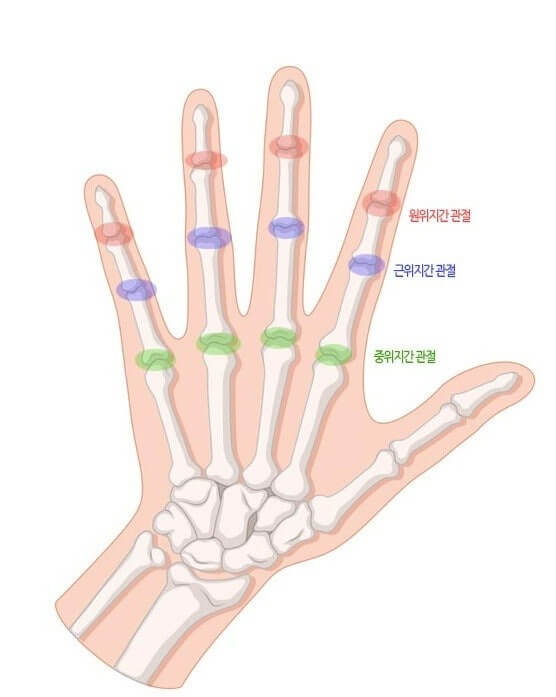 손가락 관절 통증