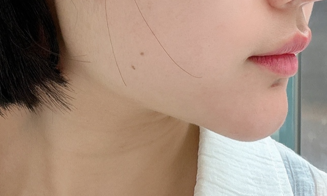 써마지리프팅효과 가격 셀리뉴리프팅