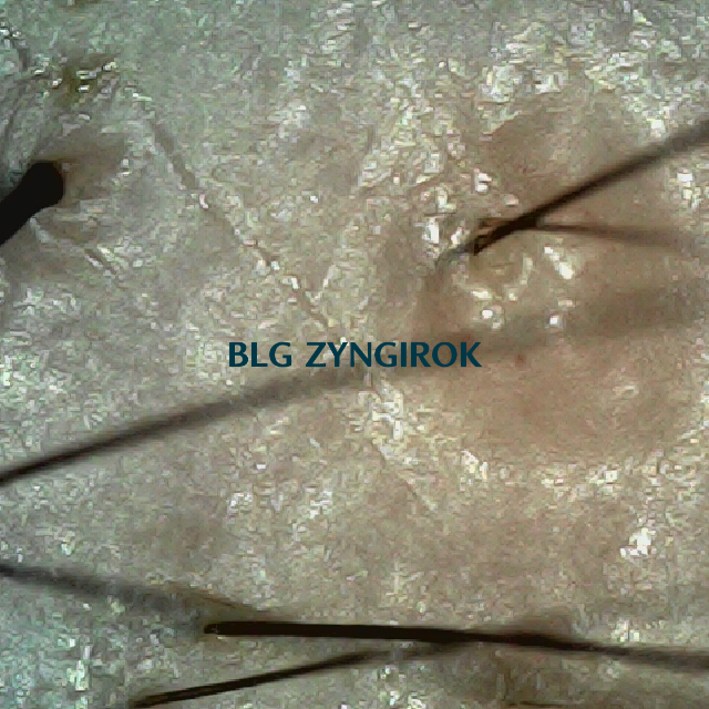 탈모 극복 프로젝트 - 오른쪽 M자 부위 두피모습 모습이다.