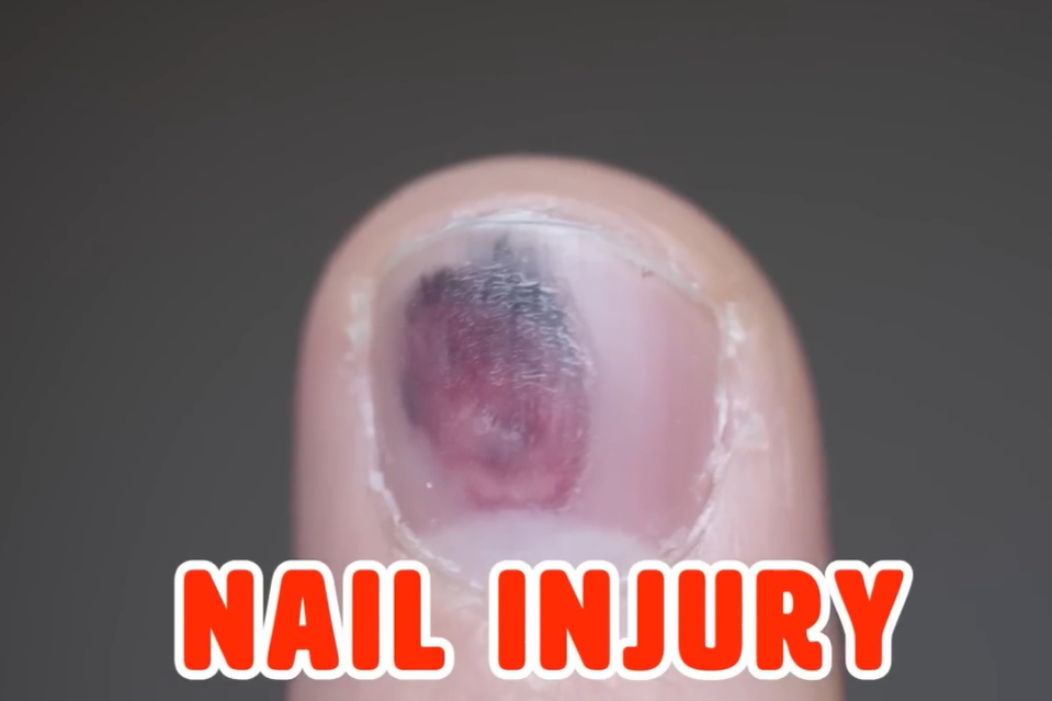 발톱이 검게 변하는 이유