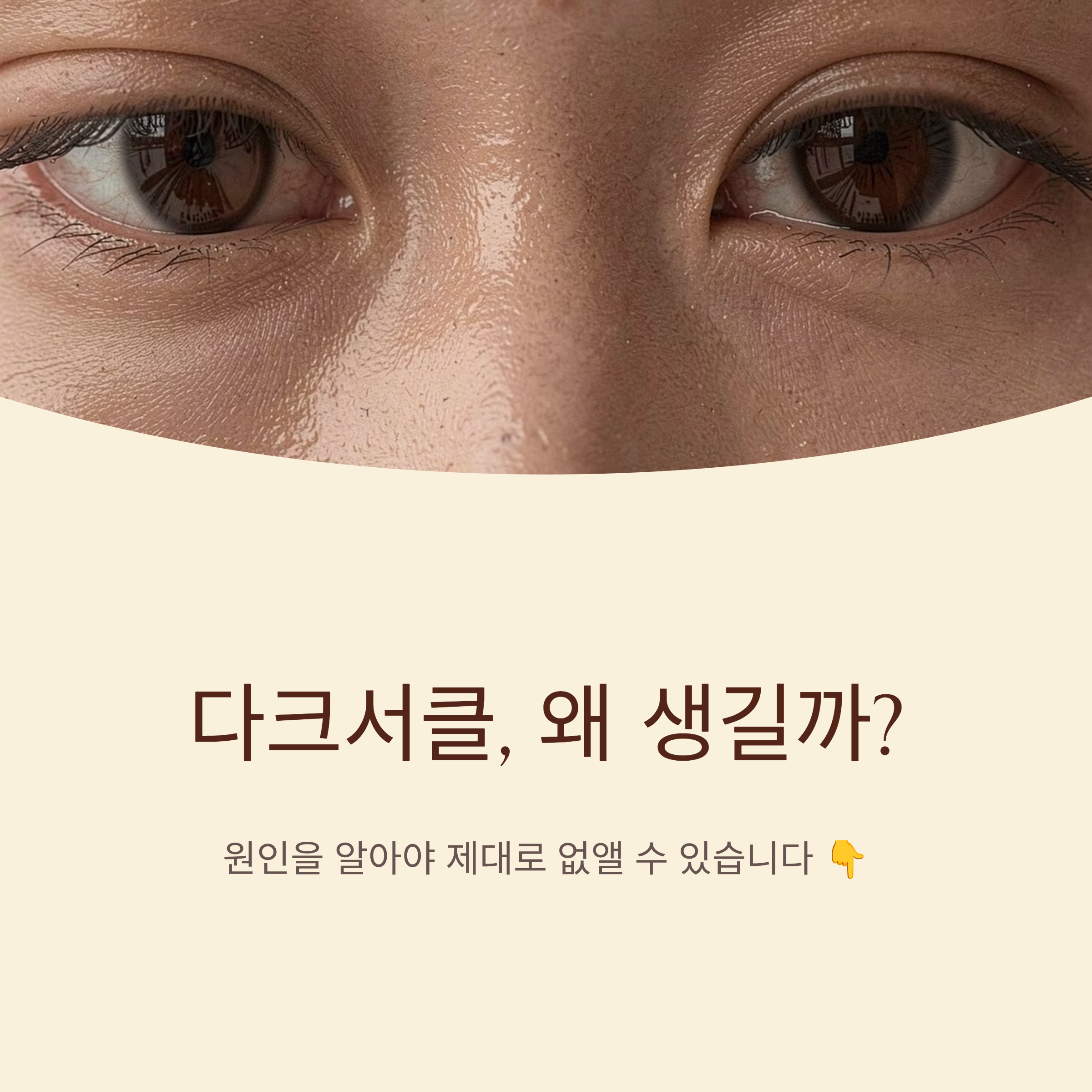 다크서클