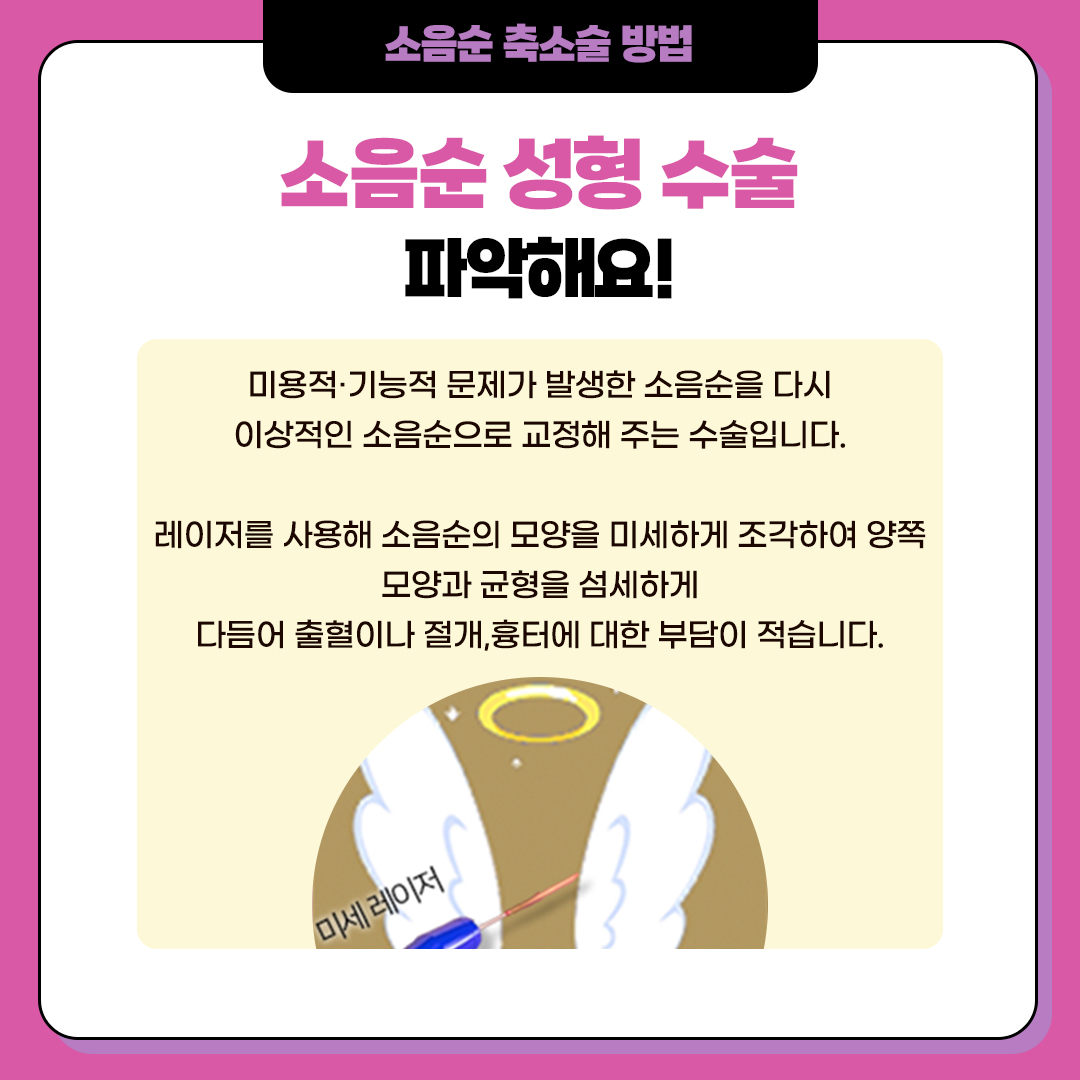 소음순 축소술 방법은?