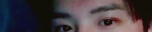 안검하수 후기