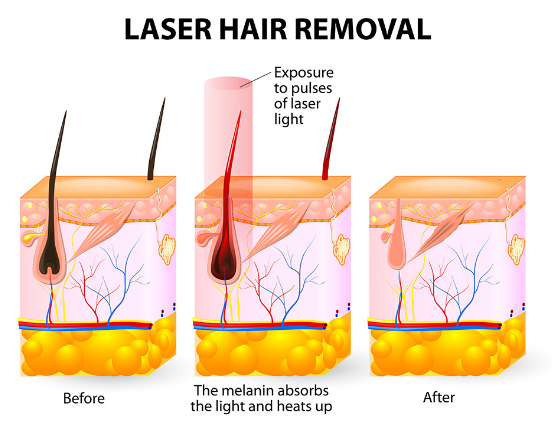 레이저 제모 원리