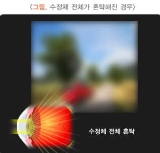 백내장 원인 증상 및 수술 치료방법 알아보기