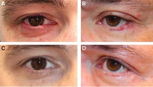 치료 경과 사진