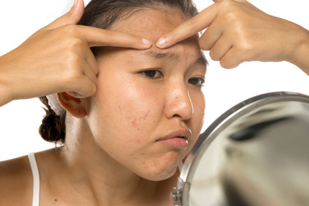 좁쌀 여드름: 원인과 효과적인 치료 방법