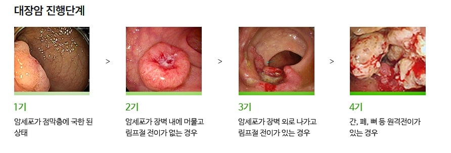 대장암-진행단계