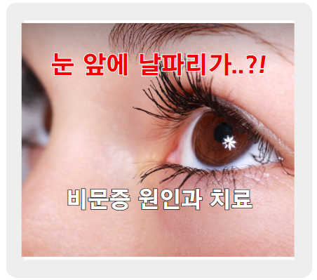 눈 앞 날파리인가! 검은 점 비문증 원인과 치료, 브로멜라인 효과까지
