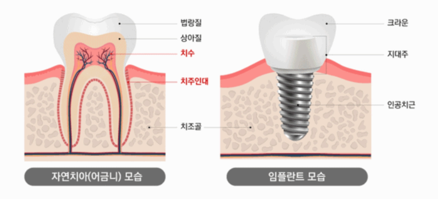 임플란트 사진