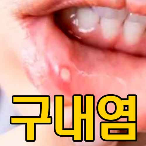 구내염 썸네일