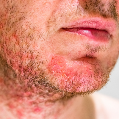 지루성 피부염 뜻과 원인, 증상, 치료법