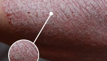 피부 붉은반점 24