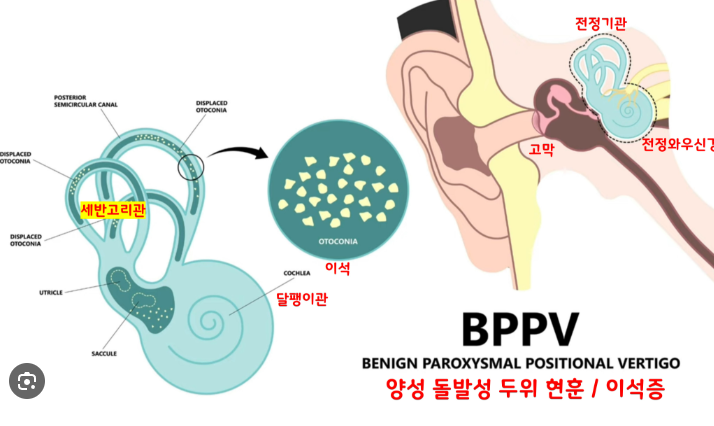이석증 재발 막는 법