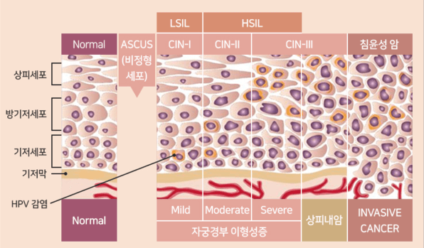 자궁경부암 진행 단계