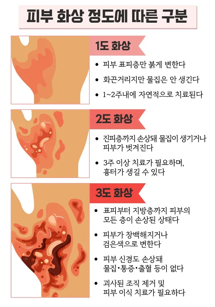 2도 화상 증상 자가치료 회복기간 응급처치법 정리_9