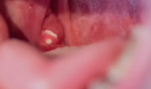 Understanding the Causes of Sewer Gas Odor, Exploring Tonsil Stone Symptoms and Treatment Methods.